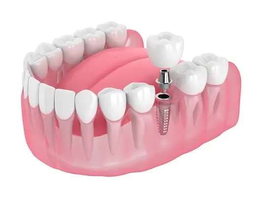 Types of Dental Implants Larchmont | Eric Spellman DMD | Restorative Dentist Larchmont